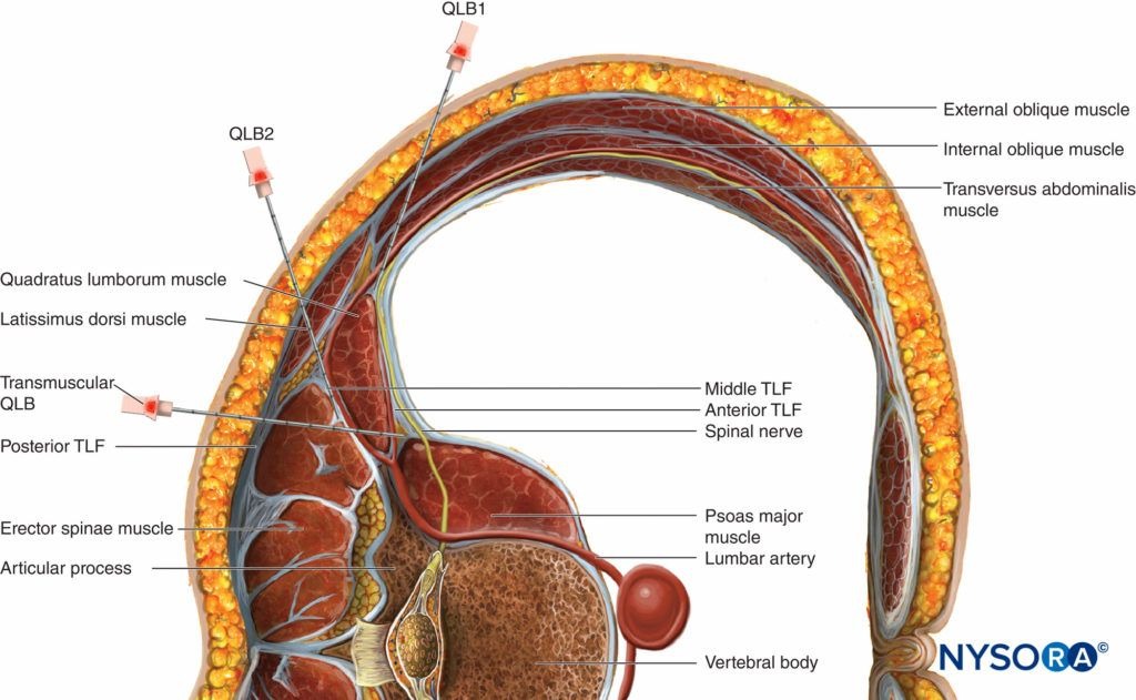 Ilustração anatômica em corte transversal mostrando os pontos de punção QLB1, QLB2 e o bloqueio transmuscular do quadrado lombar, com os músculos oblíquo externo, oblíquo interno, transverso do abdômen, quadrado lombar, latíssimo do dorso, eretor da espinha e psoas maior identificados.