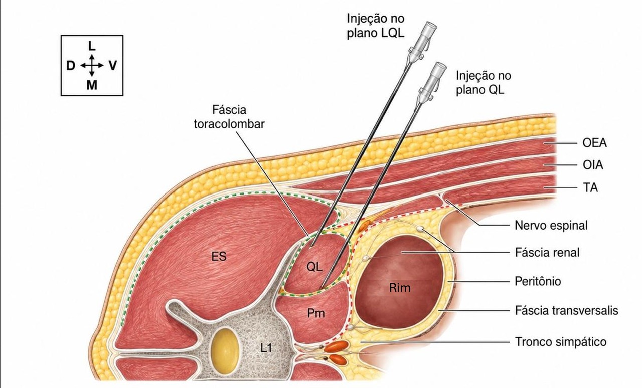 Esquema mostrando a posição da agulha para injeção no plano lateral do quadrado lombar (LQL) e no plano do quadrado lombar (QL) em um cão, ao nível da primeira vértebra lombar, com a fáscia toracolombar, o rim, o nervo espinhal e os músculos identificados.